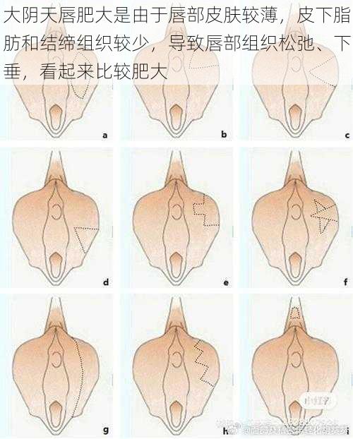 大阴天唇肥大是由于唇部皮肤较薄，皮下脂肪和结缔组织较少，导致唇部组织松弛、下垂，看起来比较肥大